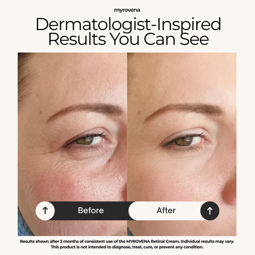 MYROVENA™ - 1% Retinal Liposome Cream + Fermented Rice