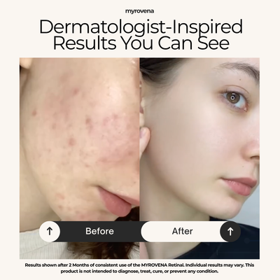 MYROVENA™ - 1% Retinal Liposome Cream + Fermented Rice