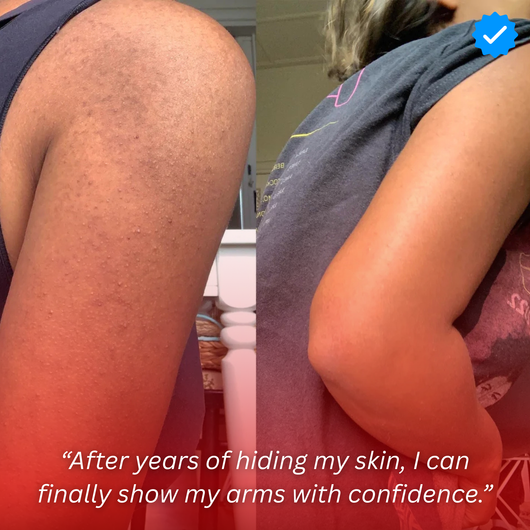 Strawberry Skin - Resurfacing Skin