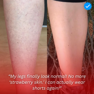 Strawberry Skin - Resurfacing Skin