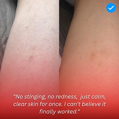 Strawberry Skin - Resurfacing Skin