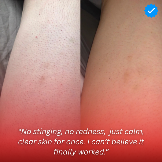 Strawberry Skin - Resurfacing Skin