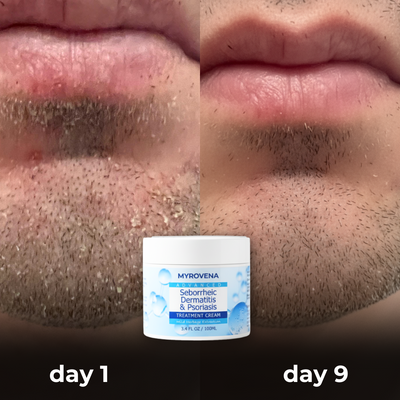 MYROVENA™ Anti-Fungal Beard Cream