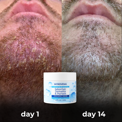 MYROVENA™ Anti-Fungal Beard Cream