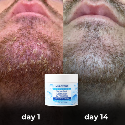 MYROVENA™ Anti-Fungal Beard Cream
